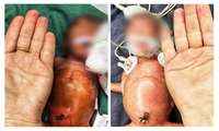 جراحی نجات بخش پارگی روده دوقلو های نارس ۷۵۰ و ۸۵۰ گرمی در بیمارستان کودکان بندرعباس
